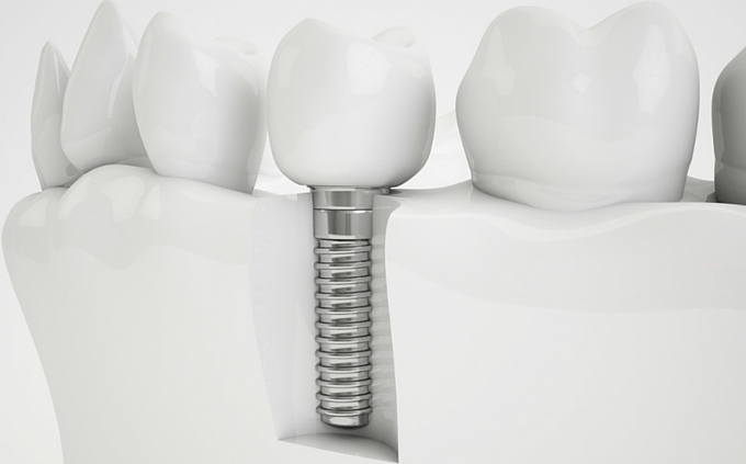 Dental Implant Health: Floss Is A Bust